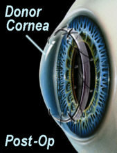 corneal transplant 3.jpg